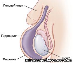 Водянка яичек у мужчин | Симптомы, причины и лечение гидроцеле