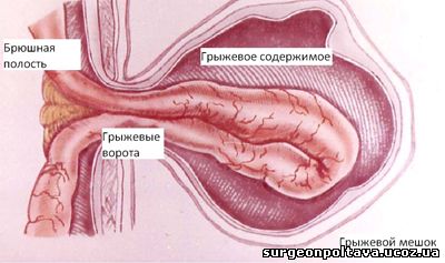 Строение грыжи живота